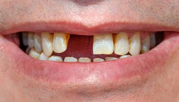 7 Common Causes of Tooth Loss—And How to Prevent Them