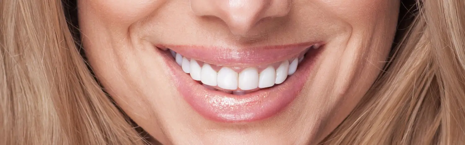 No-Prep Veneers
